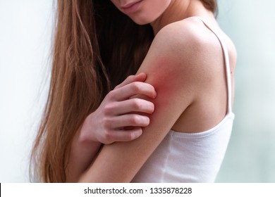 Young Woman Suffering From Itching On Her Skin And Scratching An Itchy Place. Allergic Reaction To Insect Bites, Dermatitis, Food, Drugs. Health Care Concept. Allergy Rash 