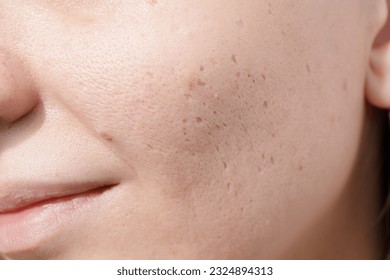 Young woman suffering from problem skin and acne closeup. Icepick scars acne on cheek 