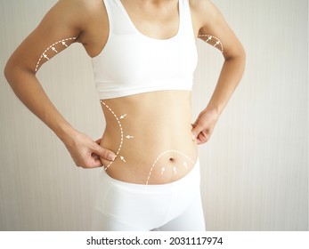 Young Woman Torso In Underwear With The Drawing Arrows And Medical Marks. Fat Lose, Liposuction, Cellulite Removal And Skin Lifting Concept. Closeup Photo, Blurred.