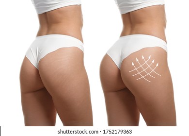Young woman in underwear before and after plastic surgery on white background