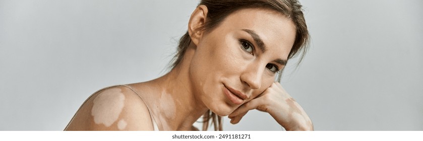 A young woman with vitiligo rests her head on her hand, gazing thoughtfully at the camera. - Powered by Shutterstock