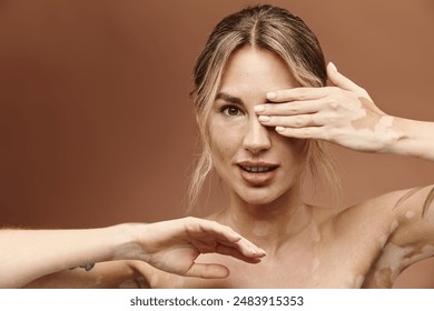 A young woman with vitiligo and a tattoo poses with her shoulders bare against a beige backdrop. Her confidence and beauty shine through. - Powered by Shutterstock