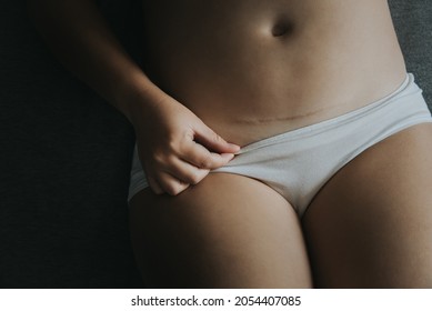 Young Woman In White Panties, Caesarean Section Scar.