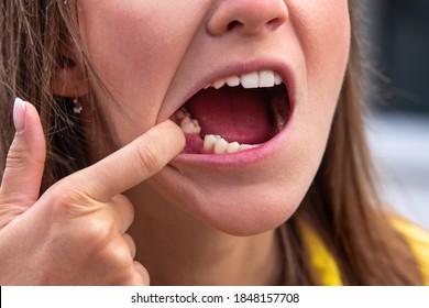 Young Woman Without Tooth On Lower Jaw. Missing Tooth. Waiting An Implant After Tooth Extraction