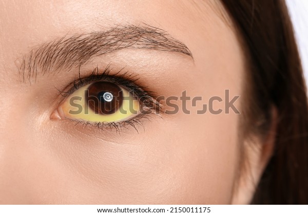Young\
woman with yellow eyes, closeup. Hepatitis\
symptom