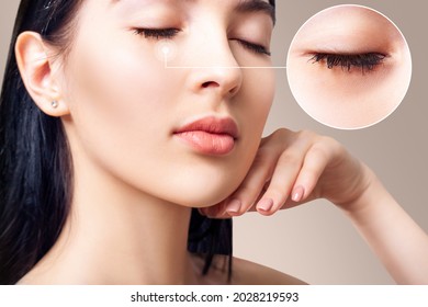 Young Woman With Zoom Circle Shows Bruises Under Eyes Before And After Treatment.