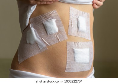 Young woman's belly after operation by laparoscopy in the hospital. The abdomen sealed with plaster after surgery to remove the gallbladder by laparoscopy in clinic. Dressings at laparoscopy wounds.