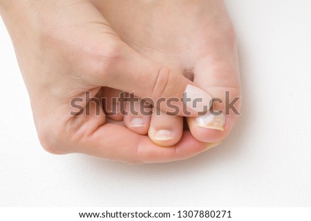 Young woman's hand using and applying moisturizing cream on foot nail. Dry, damaged toe nails. Woman's issues. Problem and solution. White background. Close up. Front view.