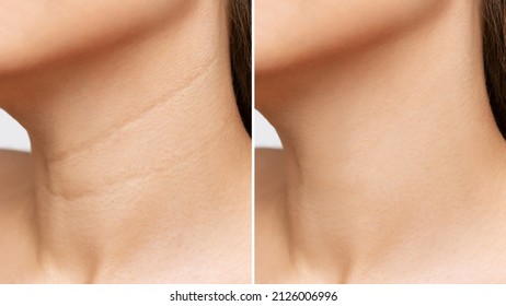 Сlose-up of young woman's neck with wrinkles before and after treatment. Result of cosmetic rejuvenating procedure. Lines, age-related changes, Venus rings.Neck lifting, collagen injections, skin care