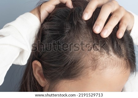 Young women stressed and having hair loss, thinning hair