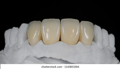 Zirconia bridge and crown with porcelain in the model for dentist