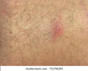 Ingrown Hairs Stock Photos Images Photography Shutterstock