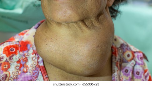 Zooming Closeup Frontal View Of Enlargement Of Thyroid Gland Causing Upper Airway Obstruction In An Old Asian Female