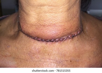 Zooming closeup frontal view of a neck after thyroid gland surgery or thyroidectomy in a middle aged Asian female patient comes with history of chronic slow progressive neck lump. Suturing line occurs