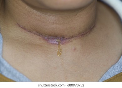 Zooming closeup frontal view of post surgical protruding turbid smelly pus discharged from neck wound after thyroid gland surgery founded in a young fat Asian female comes with severe pain at neck
