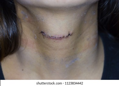 Zooming Closeup Frontal View Of Sutured Surgical Wound After Surgery To Remove Midline Neck Lump On Young Woman ' S Neck