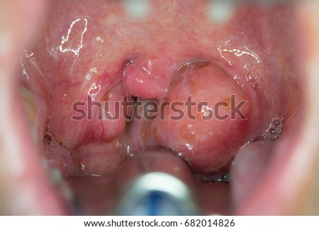 Zooming closeup intraoral view of severe enlargement of inflame tonsil glands in a middle-aged Asian woman comes with history of chronic sore throat , recurrent infection and severe swallowing