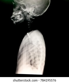 Zooming Closeup Lateral View Of Chest Radiography Showing Retained Foreign Body Of Rounded Metallic Coin In Proximal Part Esophagus In A Young Little Child With Swallowing Difficulty