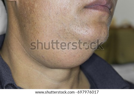 Zooming closeup lateral view of enlargement of submandibular gland and the diagnosis is hypertrophy founded in a middle-aged Asian man comes with history of slow progressive painless neck lump