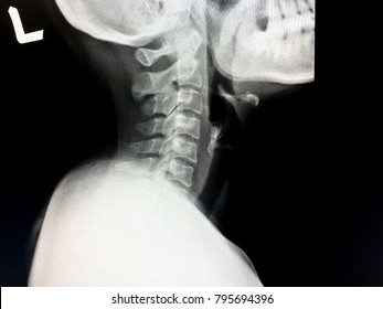 Zooming Closeup Lateral View Plain Film Neck Radiography Soft Tissue Technique Shows Abnormal Air In Proximal Part Of Esophagus In Young Asian Female Patient Comes With History Of Fish Bone Ingestion