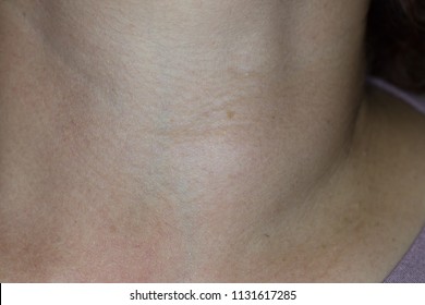Zooming closeup macro view of enlarged thyroid gland in a young woman patient comes with history of chronic slow progressive neck lump
