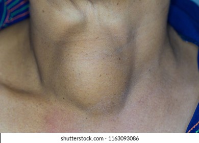 Zooming closeup macro view of extremely enlarged thyroid gland in a patient comes with history of chronic slow progressive neck lump