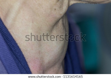 Zooming closeup macro view of extremely enlarged thyroid gland in a middle aged Asian patient comes with history of chronic slow progressive neck lump and breathing difficulty