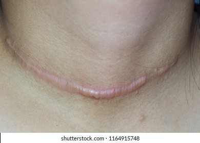 Zooming closeup macro view of large keloid or hypertrophic scar on patient 's neck after thyroid surgery