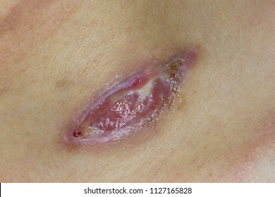Wound Infection High Res Stock Images Shutterstock