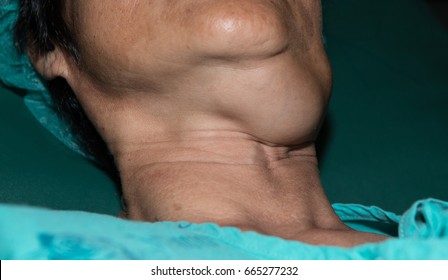 Zooming Closeup View Of Enlarged Submandibular Gland Hypertrophy At Left Side Neck In A Middle - Aged Asian Woman Comes History Of Chronic Slow Progressive Neck Lump