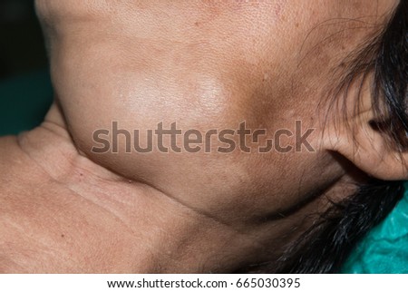 Zooming closeup view of enlarged submandibular gland hypertrophy at left side below mandible in A middle aged Asian woman comes with history of chronic slow progressive neck lump