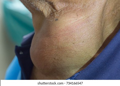 Zooming Closeup View Of Enlarged Thyroid Goiter Found In A Middle Aged Asian Male Comes With History Of Chronic Slow Progressive Neck Lump , Swallowing Difficulty And Upper Airway Obstruction