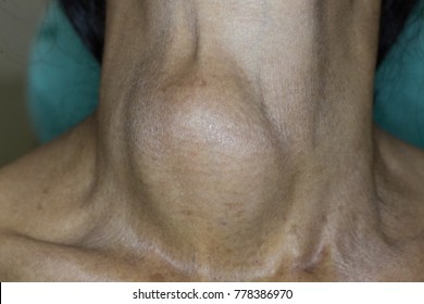 Zooming closeup view of enlarged thyroid gland on right side in an old Asian woman with history of chronic slow painless slightly movable progressive neck lump and swallowing & breathing difficulty