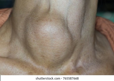 Zooming closeup view of extremely enlarged thyroid gland dominates on the right side in young Asian woman come with history of chronic slow progressive neck lump & breathing and swallowing difficulty