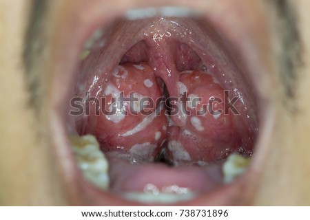 Zooming closeup view of extremely enlarged tonsil gland both sides with numerous whitish plaque on them in a young Asian man comes with history of chronic smelly breathing and swallowing difficulty