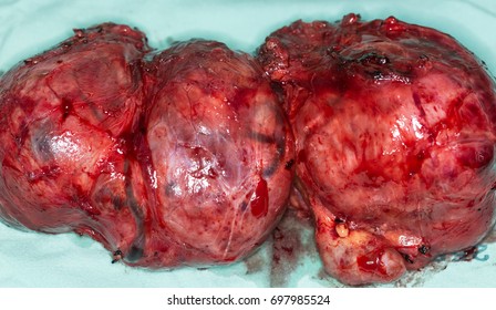 Zooming close-up view of extremely large thyroid gland after the operation to remove it all in an old Asian woman comes with history of chronic slow progressive neck lump & swallowing difficulty