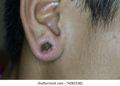 Zooming Closeup View Of Large Inflammatory Hole On Right Ear Lobule Found In A Young Asian Male With History Of Chronic Irritative Severe Or Moderate Unclean Puncture Wound For Earings Uses