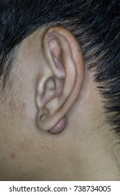 Zooming Close-up View Of Large Keloid Or Hypertrophic Scar On Left Ear Lobule Found In A Young Asian Male Comes With History Of Puncture Wound, Earings  Or Severe Injury To Diseased Ear