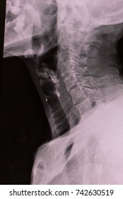 Zooming Closeup View Lateral Neck Radiograph In Soft Tissue Technique Showing Abnormal Air Column In Esophagus Suspected Of Retaining Foreign Body Causes By Large Food Particle Obstruction In Elderly