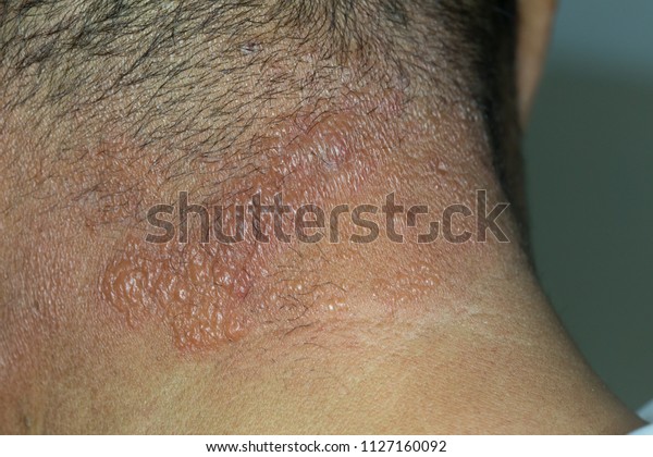 1 Skin Burn Itching Zoom Images, Stock Photos & Vectors | Shutterstock