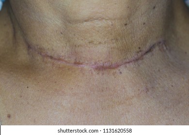 Zooming Closeup View Of Old Surgical Scar After A Thyroid Surgery On Patient 's Neck