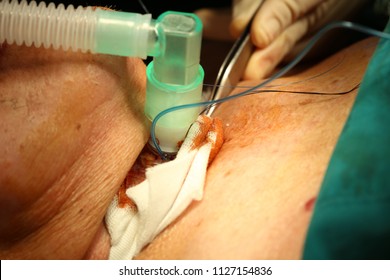 Zooming Closeup View Of Operation Of The Neck On Operating Theater Called ' Tracheotomy ' Or Tracheal Surgery To Bypass Airway In A Patient With The Diagnosis Of Upper Airway Obstruction