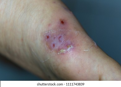 Zooming Closeup View Of Painful Reddish Inflammatory Skin With Pus On Right Foot Of A Young Asian Woman Patient Comes With History Of Abrasive Wound In Her Fell Down