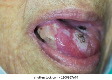 Zooming Closeup View Of Painful Ulcerative Lesion At Tongue Of An Old Asian Female Patient And The Diagnosis Is Cancer Of Lateral Side Of Tongue