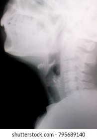 Zooming Closeup View Of Plain Film Radiography Of Lateral Neck With Soft Tissue Technique Showing Normality Of Air Column Along Laryngeal & Tracheal Pathway In A Young Asian Female Patient