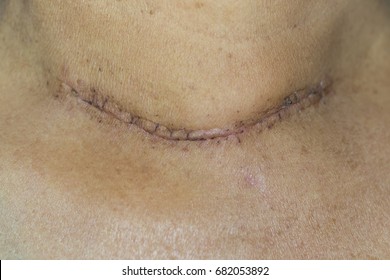 Zooming closeup view of post operative scar after thyroid surgery in a follow up day in a hospital or medical center