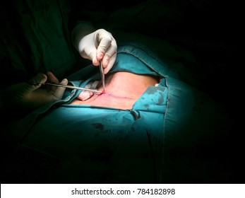 Zooming closeup view of a surgical method to suture closing skin after remove thyroid, calling thyroid lobectomy on a modern operation theater in a hospital
