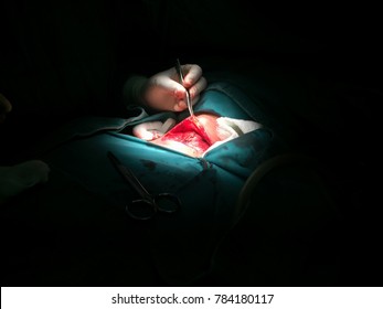 Zooming closeup view of a surgical procedure at neck to remove thyroid, calling thyroid lobectomy on a modern operative theater in a hospital in a middle aged Asian female patient in neck lump