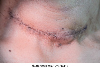 Zooming closeup view of surgical wound after thyroid surgery in a middle aged Asian woman patient in a modern rural local clinic at a public hospital