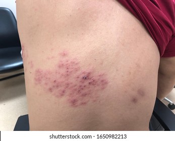 帯状疱疹 の画像 写真素材 ベクター画像 Shutterstock 帯状疱疹 の画像 写真素材 ベクター画像 Shutterstock